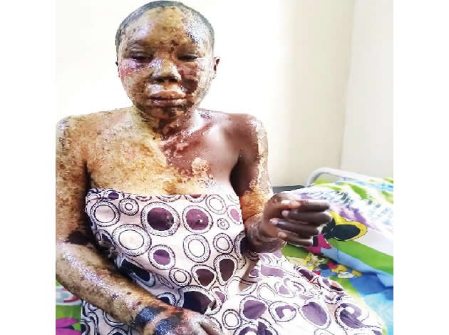 How Adamawa lady was bathed with acid for declining lover’s marriage proposal