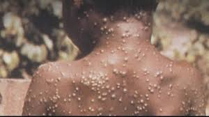 NCDC reports 60 suspected monkeypox cases in 19 states