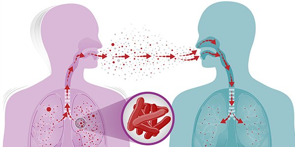 Unclean environment, malnutrition, others major causes of TB – Physicians