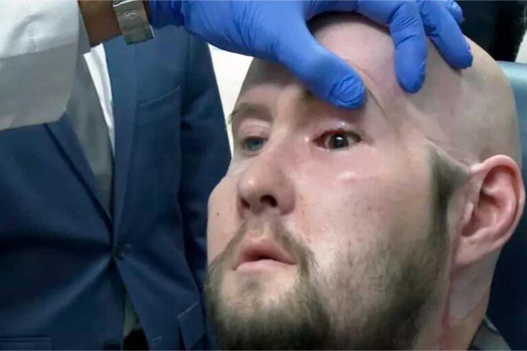 New hope for the blind as NYU surgeons conduct world's first whole eye transplant