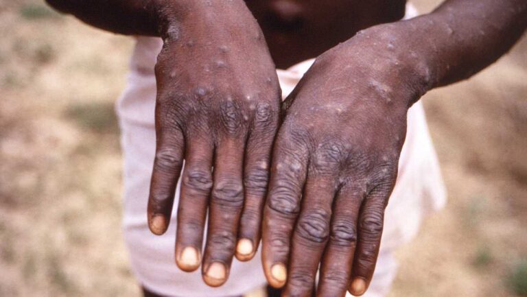 Edo reports 3 suspected cases of Mpox, urges vigilance among residents