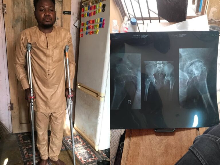 Man appeals for financial assistance to undergo surgery after okada accident