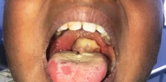 Kaduna: Suspected diphtheria outbreak kills 3 children