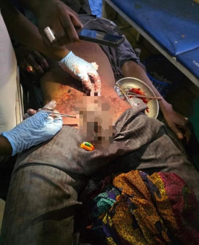 Doctors reattach genitals of Bama man after failed suicide attempt