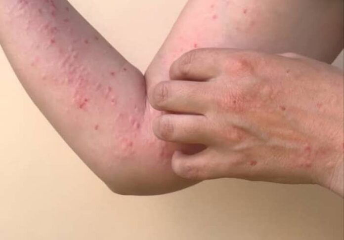 Kaduna to begin monkeypox vaccination in high-risk areas