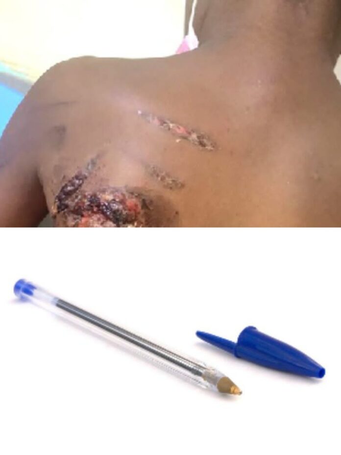 Mother remanded for allegedly burning 11-year-old son over lost pen Mother remanded for allegedly burning 11-year-old son over lost pen