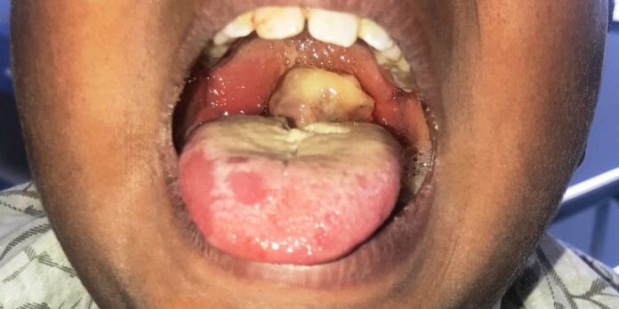 Diphtheria and the challenge to health educators out there, by Anna Gabriel Yarima